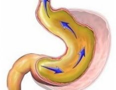 胆汁反流性胃炎能治好吗